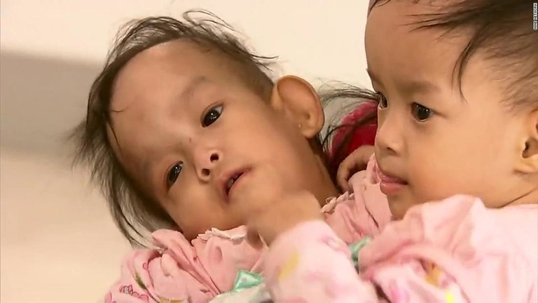 結合双生児のダワちゃんとニマちゃんの分離手術が成功した/ Nine Network 