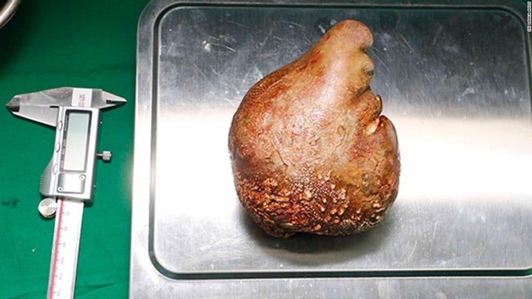 世界で最も大きく、最も重い腎臓結石がスリランカの陸軍病院で摘出された/Sri Lanka Army